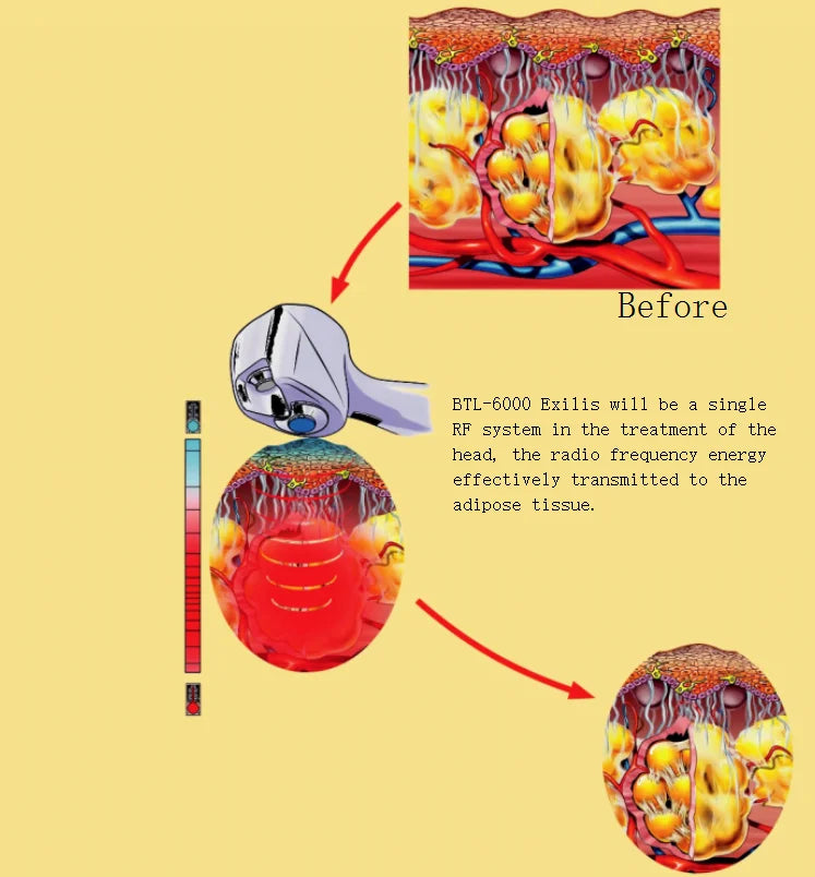 Aesthetics Ultra 360 Slimming  Machine